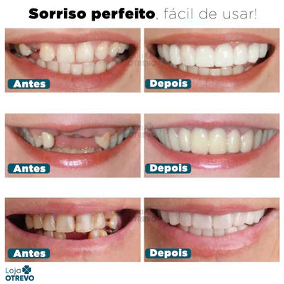 Facetas dentárias SmileFit: superior e inferior.