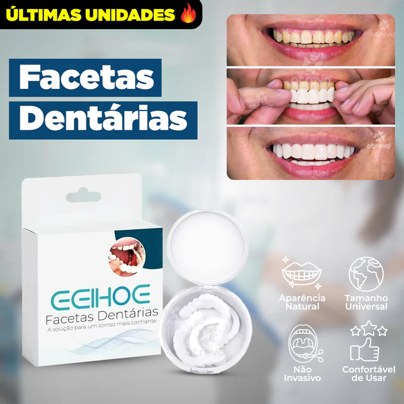 Facetas dentárias SmileFit: superior e inferior.